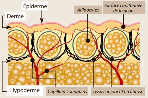 Celulite fibrosa